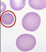下张外周血涂片圆圈所指细胞达30%，该病人最可能的诊断是（）