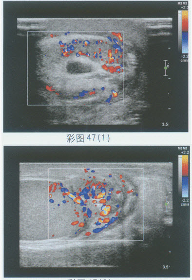 化验检查：血常规WBC升高。超声综合描述：左侧附睾增大，内回声减低不均，CDFI：内可见丰富动静脉血