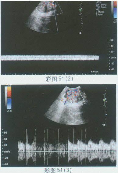 超声综合描述：左侧睾丸大小7．7cm×5．5cm，失常态，边界欠清晰，内回声明显不均，CDFI：内可