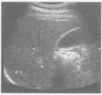 超声综合描述：肝右叶可见1．4cm×1．0cm增强回声区，边界清晰，CDFI：内未见动静脉血流信号。