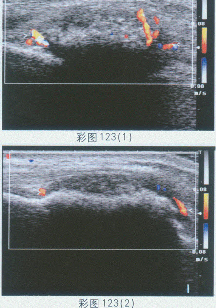 超声综合描述：左腕部扫查骨皮质连续中断，呈虫蚀样，可见6．7cm×2．2cm不均质回声区，中部回声强