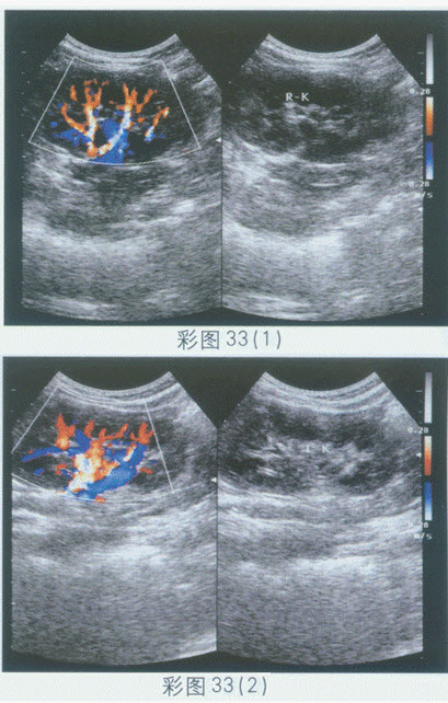 超声综合描述：右肾9．1cm×4．5cm×3．9cm，左肾9．5cm×4．3cm×3．7cm，双肾皮