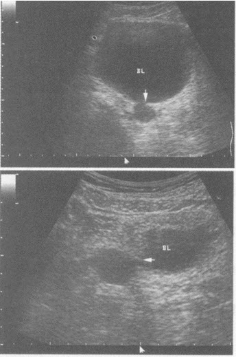 超声综合描述：膀胱充盈良好，横切面于膀胱6：00可见1．7cm×1．5cm圆形无回声区，与膀胱相通（