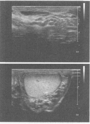 临床物理检查：左侧阴囊可扪及条索状肿物，质软。超声综合描述：左侧阴囊根部精索纵断可见纡曲的管状结构，