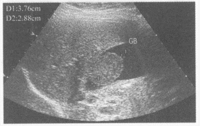 超声综合描述：胆囊壁可见3．76cm×2．88cm中强回声光团，与壁相连，后方无声影，不随体位变化而