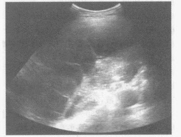 超声综合描述：左侧胸腔内可见大片状无回声区，呈网格状，最大深度4．8cm；其上方胸膜厚度1．1cm，