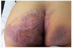 患者男，38岁，因“左侧臀部暗红色斑块11年来诊”。斑块逐渐呈疣状增生，且向周围扩展，以后中心部分的