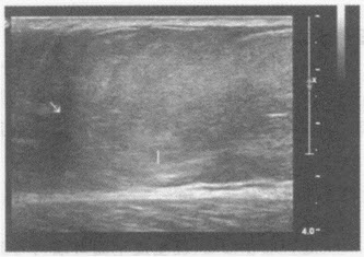 超声综合描述：右大腿皮下可见8．0cm×6．1cm增强回声区，边界清晰，形态规则，CDFI：内未见明