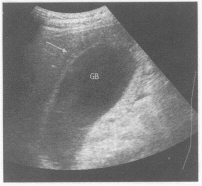 超声综合描述：胆囊大小9．1cm×4．2cm，囊壁部分呈双边，胆囊前壁外可见条样无回声（箭头所示），