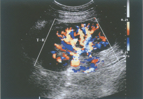 超声综合描述：右髂窝可见移植肾，形态大小正常，皮髓界限清晰，集合系统未见分离，移植肾周未见明显异常回