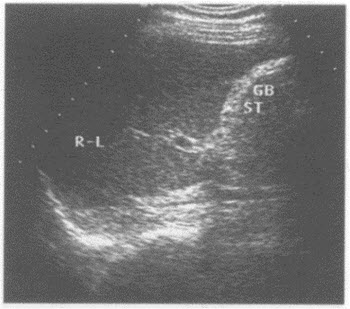 超声综合描述：胆囊内未见透声，可见弧性强回声光带，后伴声影。超声提示（）