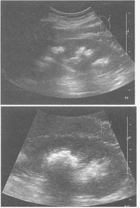 化验检查：尿常规红细胞3+。超声综合描述：双肾形态、大小正常，沿肾锥体分布可见多个强回声光团，后伴声