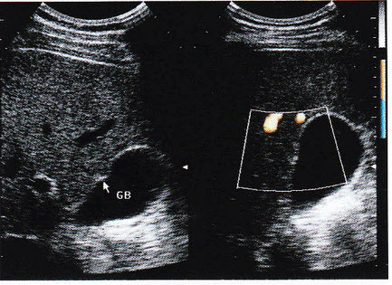 超声综合描述：肝右叶胆囊前壁外可见0．8cm×0．6cm稍低回声区，边界清晰，胆囊前壁受其推挤向内凹