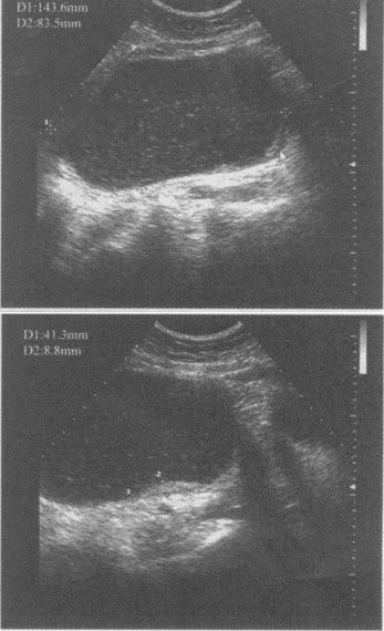超声综合描述：膀胱充盈良好，内透声不清亮，可见由中强回声光点聚合而成的中强回声区，范围4．1cm×0