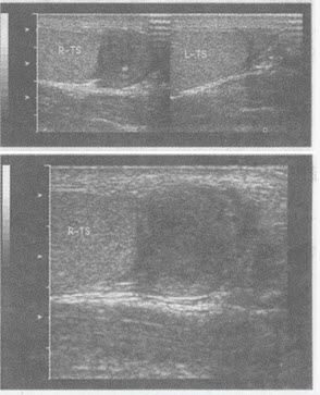 化验检查：血常规WBC升高。超声综合描述：右侧睾丸形态、大小正常，内回声均匀。右侧附睾尾回声减低，范