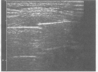 临床物理检查：右第三肋触痛明显。胸部X线：两肺未见异常。超声综合描述：右第三肋骨皮质强回声带连续中断