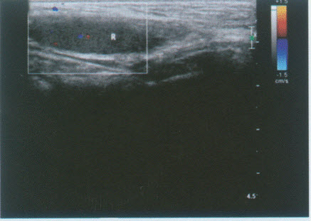 临床物理检查：右侧阴囊内未扪及正常睾丸，左侧阴囊内可扪及正常睾丸。超声综合描述：左侧睾丸2．1cm×