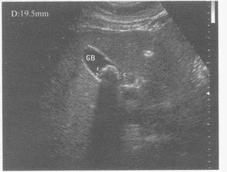 超声综合描述：胆囊壁毛糙，内可见直径2．0cm弧形强回声光带（超声提示（）