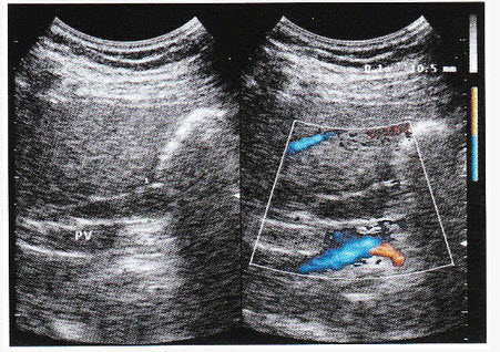 超声综合描述：门静脉前方可见直径1．1cm管状无回声，内透声清亮。见下列彩图。超声提示（）