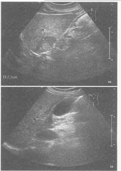 超声综合描述：肝回声增强，肝右叶及胆囊前壁外可见片状低回声区。超声提示（）