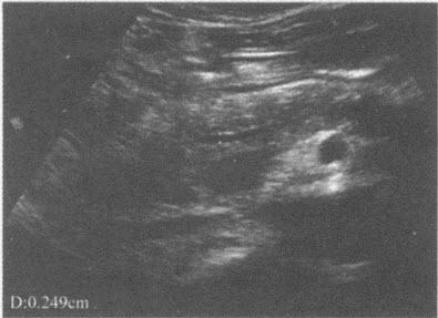 化验检查：血淀粉酶260U。超声综合描述：胰腺轮廓显示欠清，表面不平，回声强弱不均，MPD间断显示，