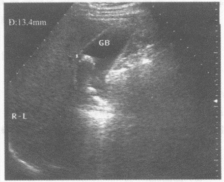 超声综合描述：胆囊内可见大小不等强回声光团，最大直径1．3cm，后伴声影，可随体位变化而移动。超声提