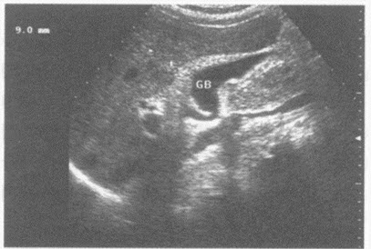 超声综合描述：胆囊形态大小正常，胆囊前壁增厚，厚度0．9cm，回声不均，囊内透声清亮。超声提示（）