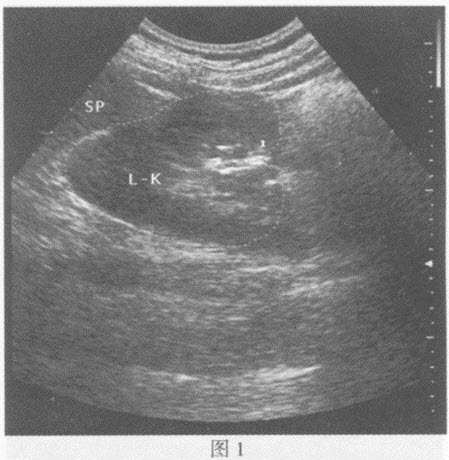 超声综合描述：左肾形态失常，纵切呈"C"形（图1、图2），肾门指向右侧。见下图及彩图34。超声提示（