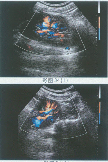 超声综合描述：左肾形态失常，纵切呈"C"形（图1、图2），肾门指向右侧。见下图及彩图34。超声提示（