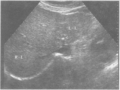 超声综合描述：肝左叶可见直径0．4cm强回声光团，后伴声影。超声提示（）