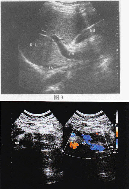 超声综合描述：右上腹可见脾脏（图1），左上腹可见肝脏（图2），腹主动脉位于脊柱右前方，下腔静脉位于脊