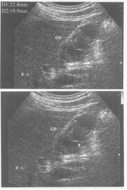 超声综合描述：胆囊形态大小正常，胆囊壁不均匀增厚，内可见2．3cm×2．0cm鹿角形中等回声，边界清