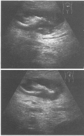 化验检查：便潜血阳性。超声综合描述：右上腹扫查可见假肾样低回声区，中部可见气体样强回声，周边回声低。