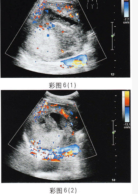 超声综合描述：图1、彩图6（1）：肝右叶可见12．2cm×8．3cm不均质回声区，边界尚清，内回声明