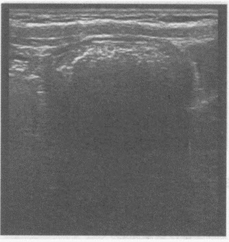 超声综合描述：上腹部可见弧形强回声光带，后伴声影，动态观察内未见蠕动。超声提示（）