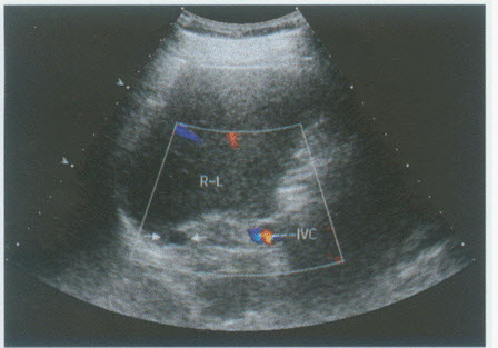 超声综合描述：肝右叶后方与下腔静脉间可见0．8cm×1．0cm类圆形低回声区（箭头所示），边界清晰，