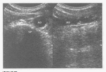 超声综合描述：腹主动脉内膜粗糙，连续性差，管壁回声强弱不均，可见多个大小不等强回声、中等回声光团，部