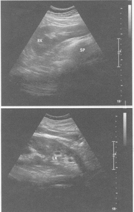 超声综合描述：双肾形态失常，双肾下极靠近脊柱，腹主动脉与下腔静脉前方可见一低回声区与双肾下极相连（箭