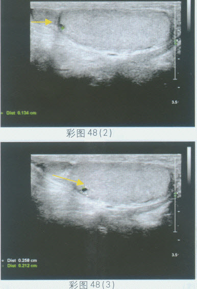 超声综合描述：左侧睾丸形态、大小正常，可见数个无回声区，边界清晰，内透声清亮，包膜完整，后方声加强。