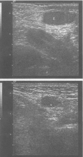 临床物理检查：左侧阴囊内未扪及正常睾丸，右侧阴囊内可扪及正常睾丸。超声综合描述：右侧睾丸1．5cm×