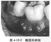 患者，女性，48岁，教师。	主诉：右上后牙牙床肿痛3天。	现病史：3天来右上后牙牙床肿胀疼痛，自感该