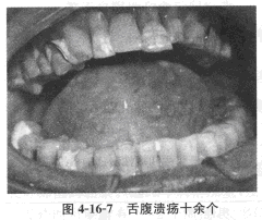 患者，男，47岁，职员。	主诉：口内溃疡剧痛2天就诊。	现病史：口腔内溃烂反复发作十余年，近几年病情