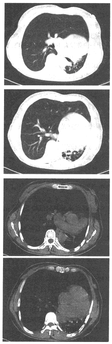 女，50岁，查体发现纵隔向左移位，行胸部CT扫描如下图。关于一侧肺发育不全的临床表现，下列说法正确的