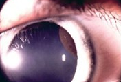 患者，女性，25岁，诉右眼胀痛，检查左眼视力1.0，裂隙灯检查如图，对该病描述不对的是（）