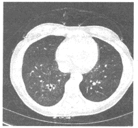 女，39岁，发热、咳嗽1周，WBC：15×109/L，胸部CT平扫如图图中所示的支持此诊断的征象为（