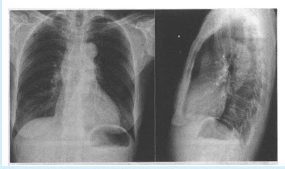 该患者的胸部CT如下图，前纵隔内类圆形肿物，密度稍低于骨骼肌密度，最可能的诊断是（）