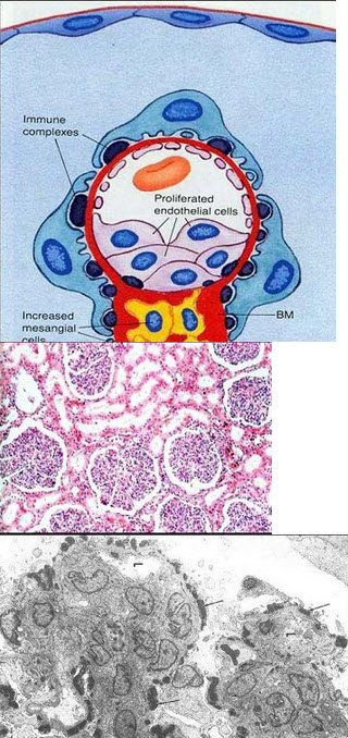 通过阅读模式图和下列两张肾脏病理图片，其诊断考虑为()