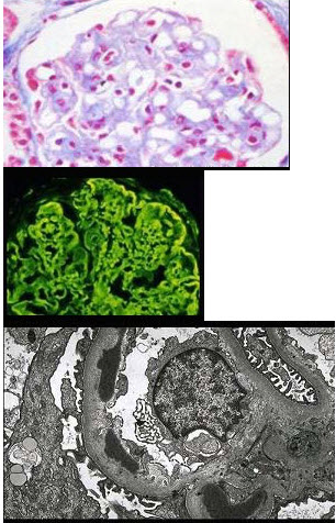 阅读下列三张病理图片(图-1Masson染色，图-2免疫荧光镜下IgG基膜内条带状沉积，图-3电镜下