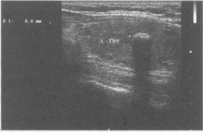 临床资料：男，48岁，常规体检。超声综合描述：甲状腺左叶可见直径0．9cm弧形强回声光带，后伴声影。