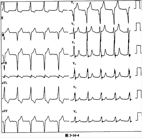 患者女性，25岁，阵发性心悸6年。平时心电图显示为预激综合征，心电图如图3-16-4所示，旁路可初步